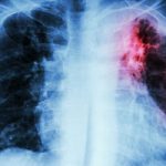 Israel Researchers Develop Algorithm That May Help Predict Onset Of Tuberculosis